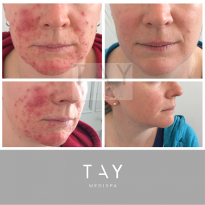 Skincare with ZO Skin health - acne treatment