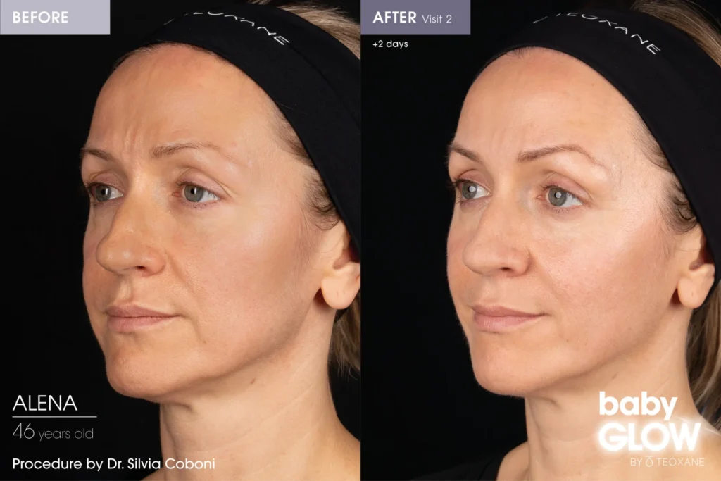 Teoxane BabyGlow Before and after